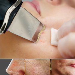 M003A   PEELING KAWITACYJNY BEZPRZEWODOWY 5w1 DO TWARZY -U017